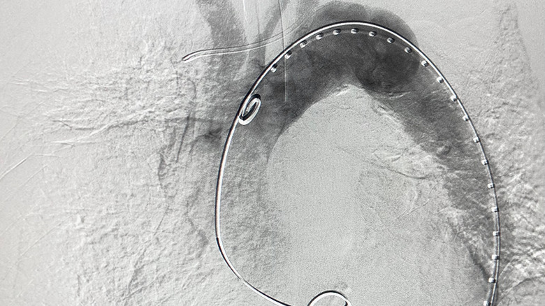 a modern scan of an aorta during repair