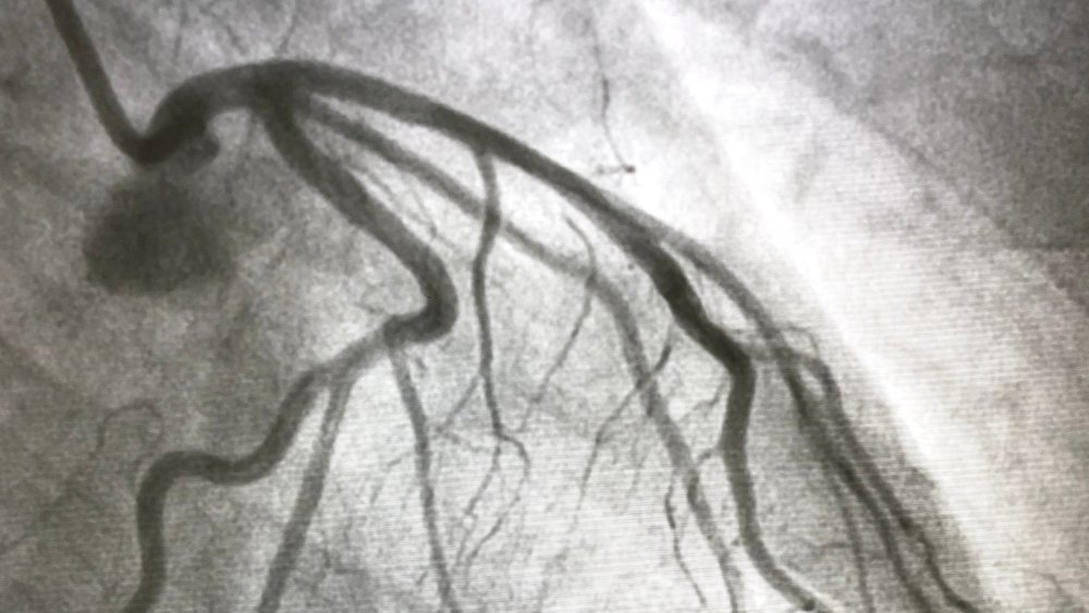Coronary angiogram of left coronary artery in cardiac catheterization room