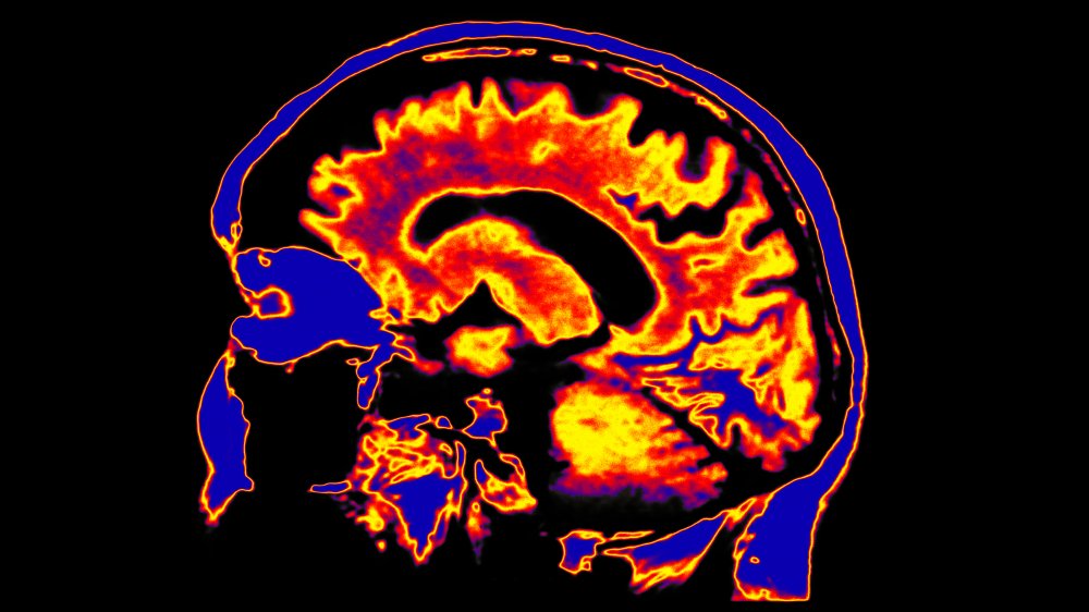 fMRI of the brain