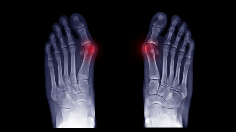 x-ray of feet with bunions