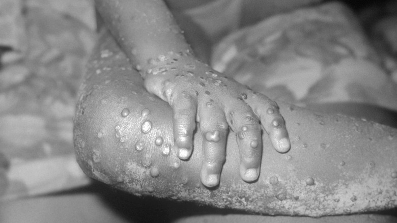 Monkeypox lesions, Liberia