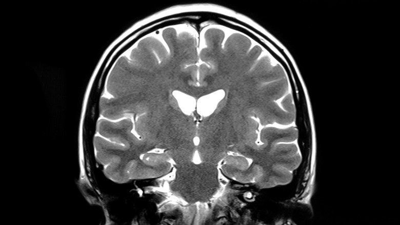 MRI scans brain