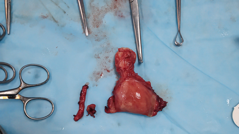 uterus cut out medically 