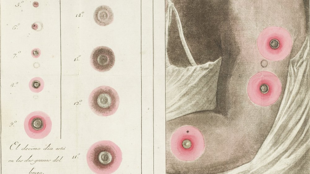 Illustration of arm with smallpox pustules