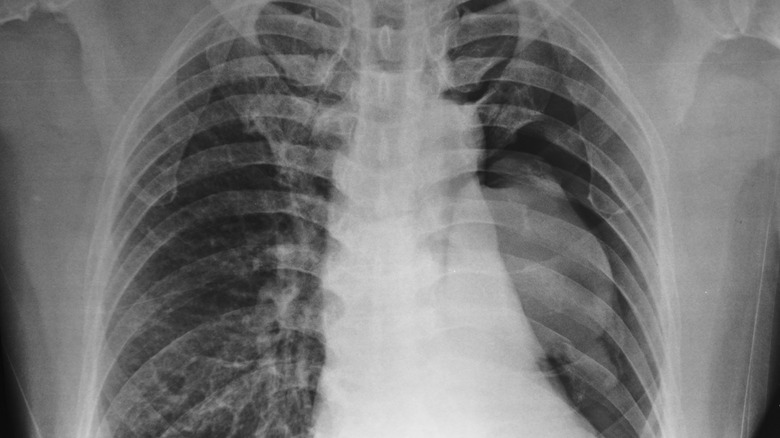 x-ray Collapsed left lung