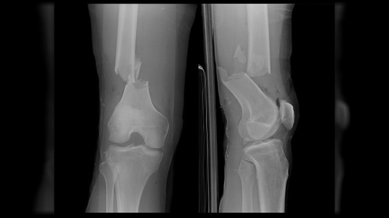 x-ray broken femur left leg