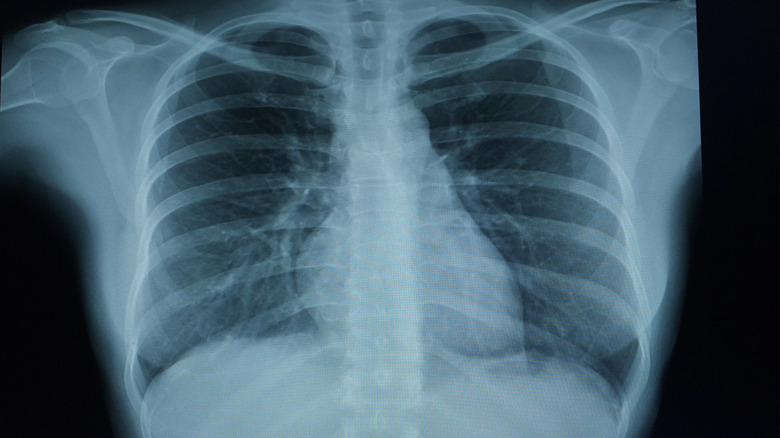 x-ray of Cracked lower rib