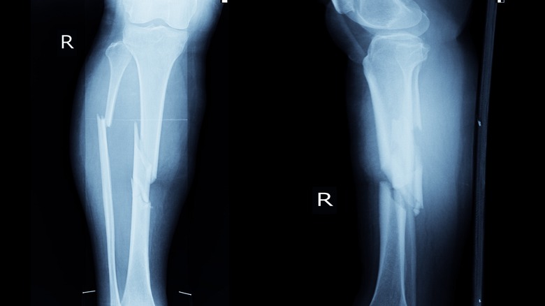x-ray Broken tibia and fibula on both legs