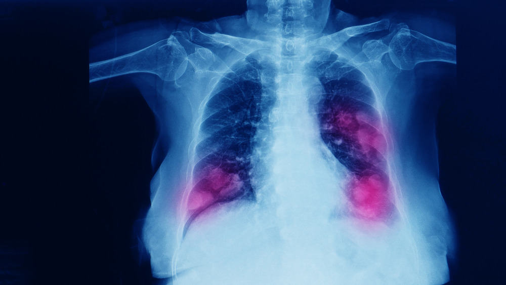 tuberculosis in lung