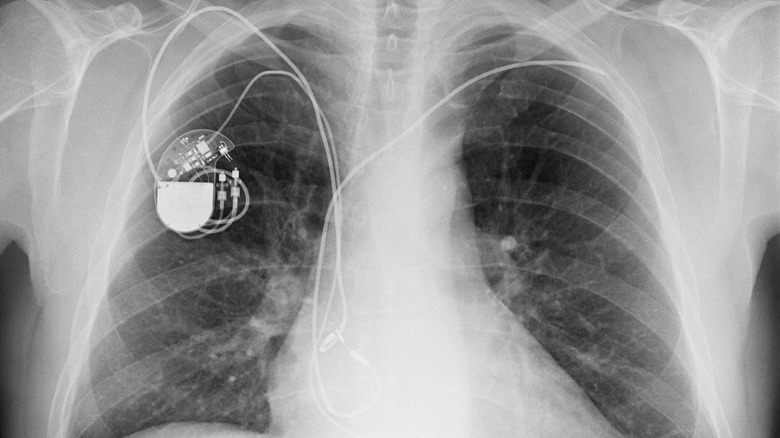 Pacemaker in x-ray