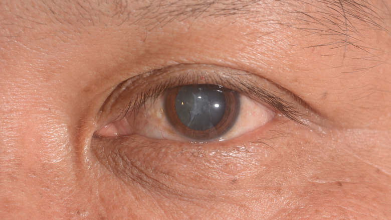Close-up shot of eye cataract