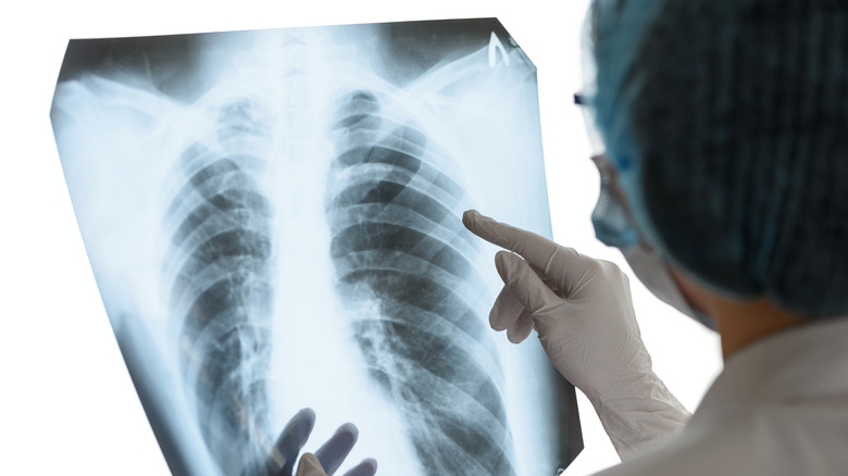 Examining a lung x-ray